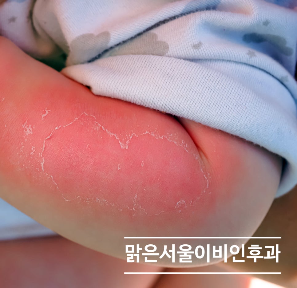 [의정부 햇빛알레르기] 외출만 하면 간지러우신가요? 햇빛알레르기 일 수도 있습니다