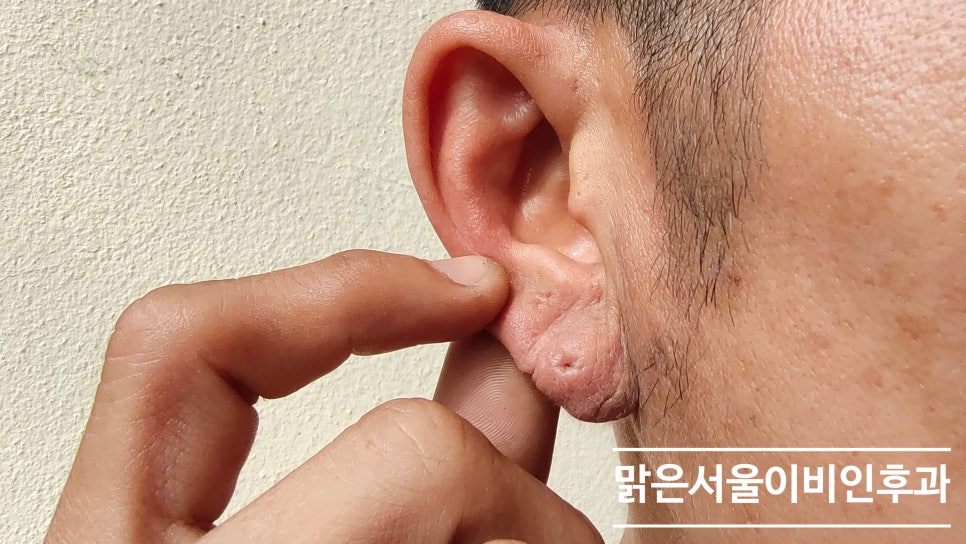 [별내이비인후과] 물놀이 후 외이도염 주의보!