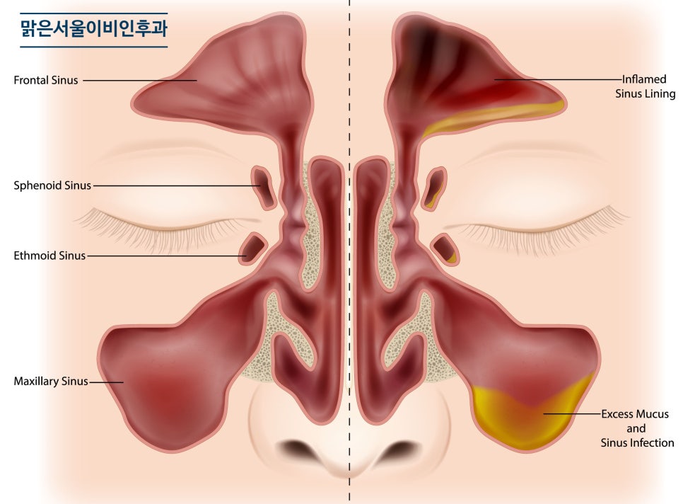 [의정부역이비인후과] 부비동이란 무엇인가?[부비동염]