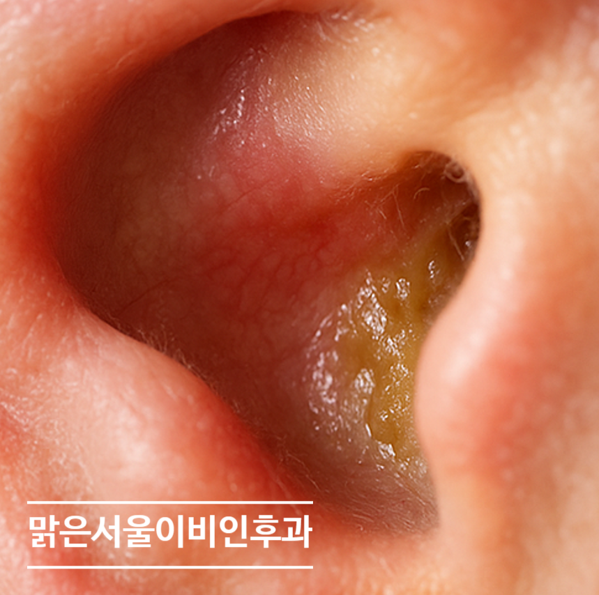 [의정부역이비인후과] 이어폰 오래 끼면 귓속에 세균이?