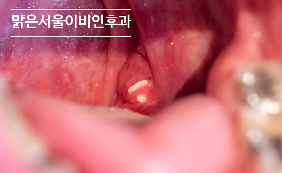 [별내이비인후과] 구취는 왜 생길까요?