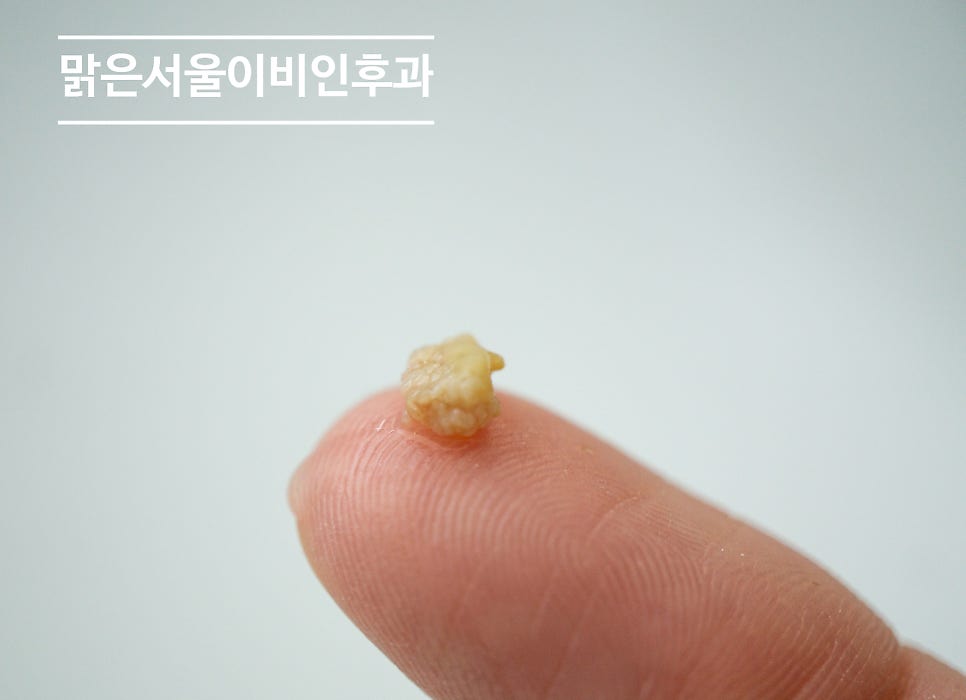 [포천이비인후과] 편도결석이 무엇인가요?