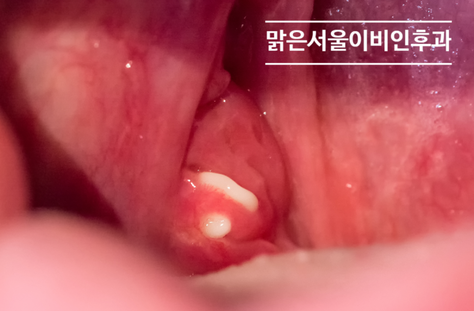 [구리이비인후과] 편도결석이 생기는 이유는?