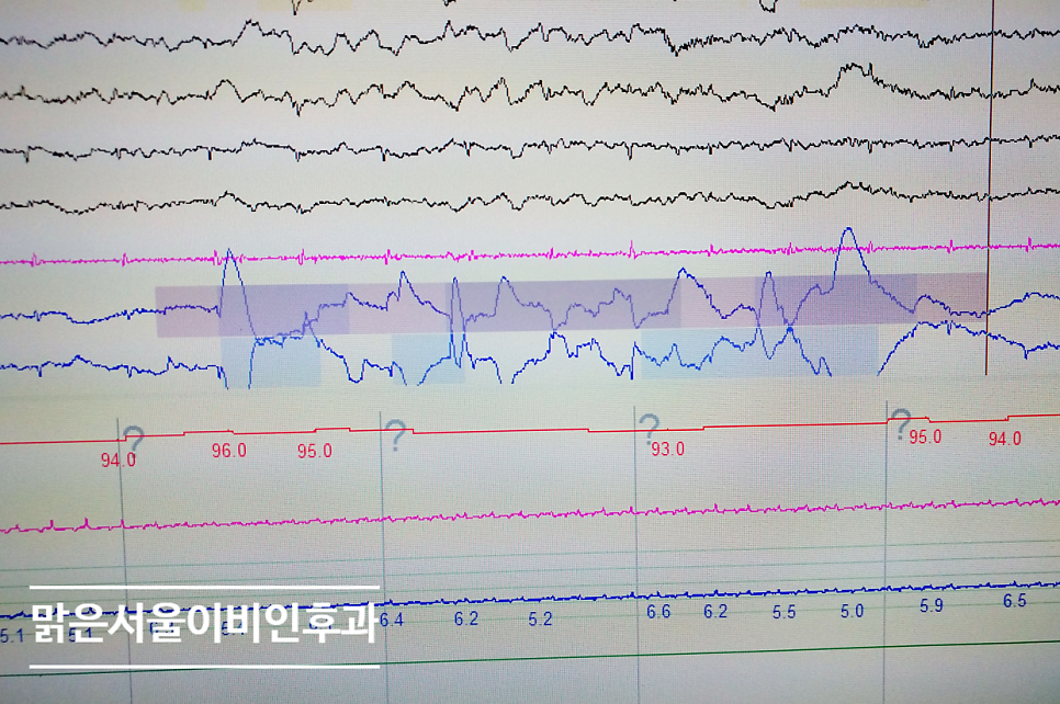 [구리이비인후과] 코골이가 심하다면 수술이 꼭 필요한가요?