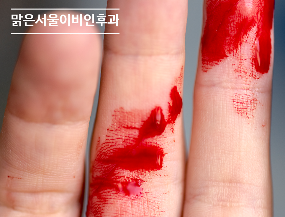 [포천이비인후과] 코피가 자주 난다면? 비강건조증의 모든 것