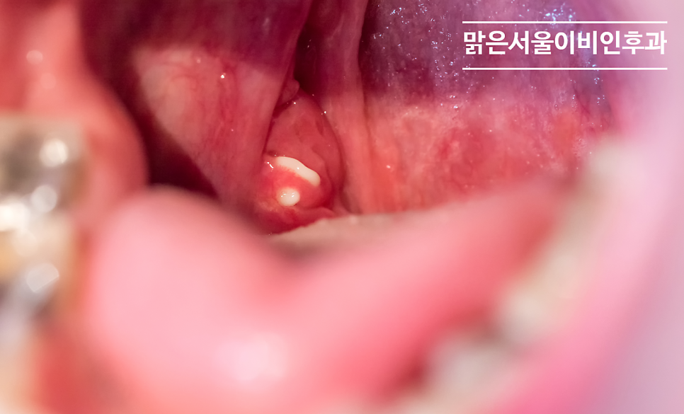 [남양주이비인후과] 편도 결석이 생기는 이유는?