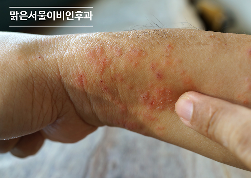 [노원이비인후과] 맑은 날 외출하고 오면 간지럽다면? 햇빛알레르기?